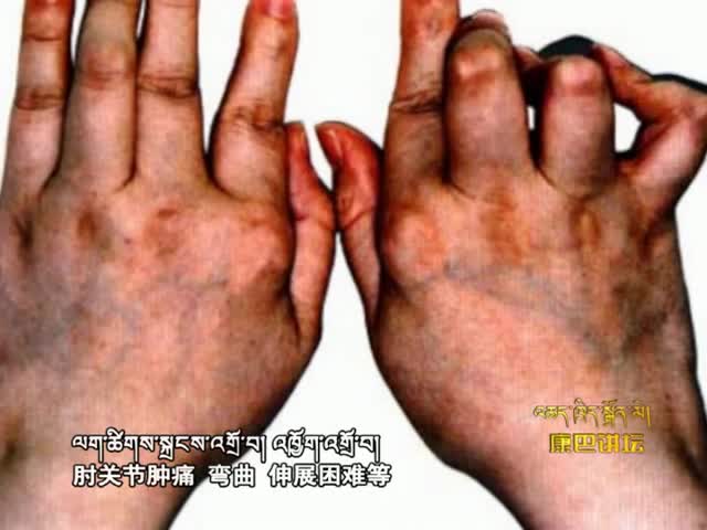 藏醫(yī)學(xué)預(yù)防關(guān)節(jié)炎（16.09.13）